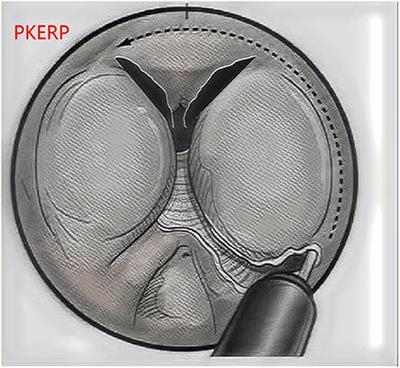 Research on Applications of Transurethral Plasmakinetic Enucleation of the Prostate in Elderly Patients Aged ≥80 Years